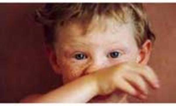علائم آلرژی در بچه ها
