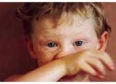 علائم آلرژی در بچه ها